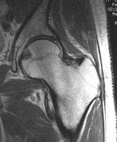 صورة بالرنين النغناطيسي لمفصل الفخذ تبين العظام و الأنسجة المحيطة بها