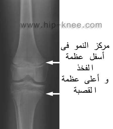 إصابة مركز نمو العظام عيادة الركبة و الفخذ