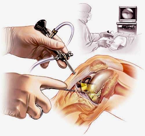 Knee Arthroscopy Hip And Knee Clinic