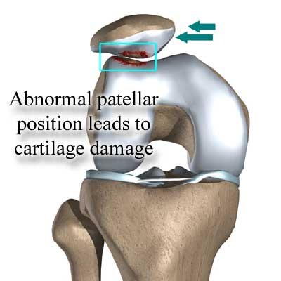 abnormal position of the patella leads to cartilage wear