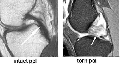 Posterior Cruaciate Ligament Injury Hip And Knee Clinic