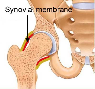 Synovitis is inflammation of the synovium lining the hip joint
