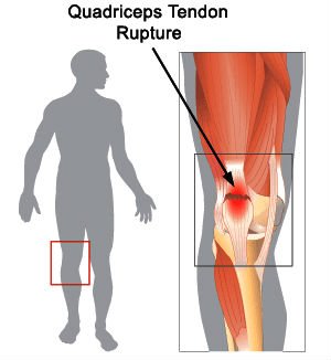 quadriceps tendon injury