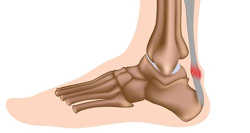 التهاب وتر اخيل وتر اكيلس Achilles Tendinitis عيادة الركبة و الفخذ 6249