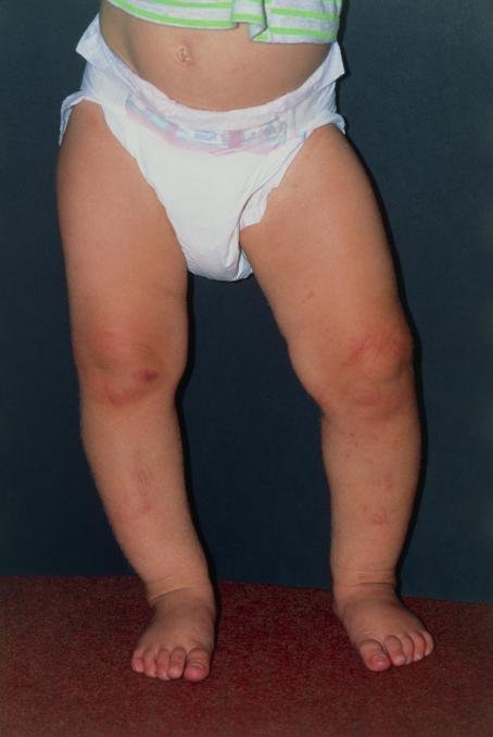 طفل يعاني من تقوس الساقين للخارج