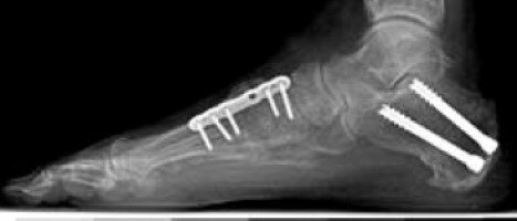 أشعة لجراحة معقدة تتضمن نقل الوتر ودمج للعظام في مشط القدم وقطع وترقيع في الكعب.