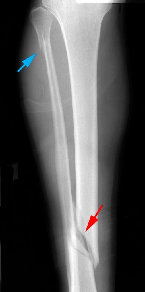 أشعة توضح كسر في عظمة الساق 