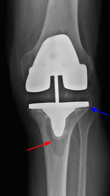 تخلخل مفصل الركبة الصناعي مما يستدعي جراحة إعادة تركيب مفصل الركبة الصناعي مرة أخرى