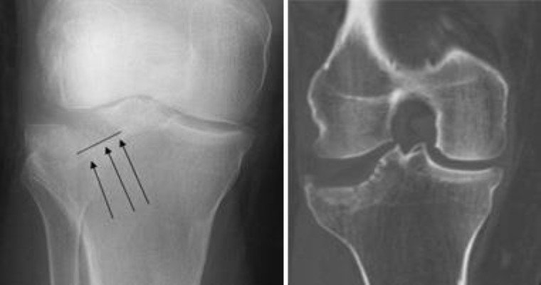 أشعة X-ray توضح كسر في مفصل الركبة