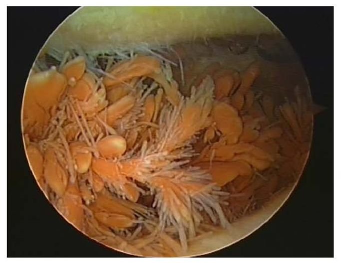 صورة داخلية لالتهاب الغشاء الزلالي الزغابي العقدي المُتصبغ