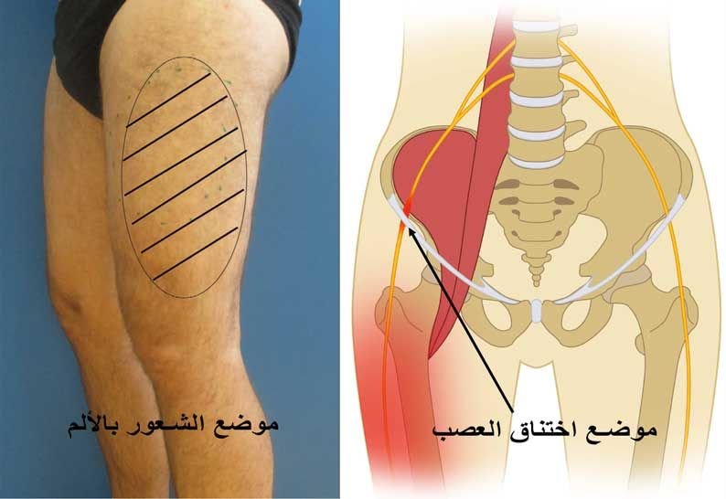 انضغاط العصب الجلدي الفخذي الوحشي مسببًا ألم الفخذ المذلي