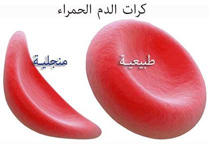 الخلايا المنجلية نتيجة تشوه كرات الدم الحمراء