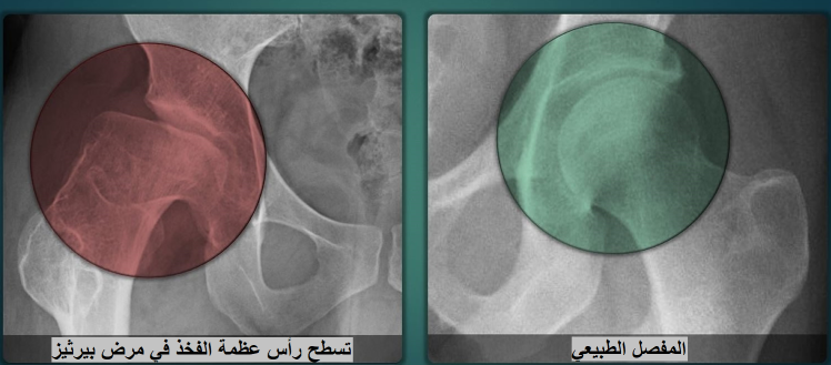 مقارنة بين أشعة مفصل الفخذ الطبيعي و مفصل الفخذ المصاب بمرض بيرثيز