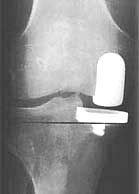 أشعة تظهر المفصل الجزئي بعد تركيبه