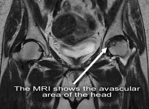 Avascular necrosis of femoral head - Hip and Knee clinic