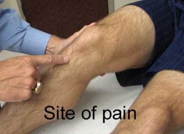 Osgood Schlatter disease - Hip and Knee clinic