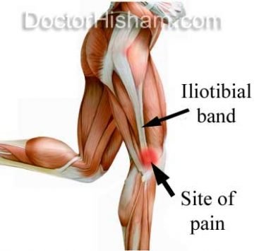 Iliotibial band syndrome - Hip and Knee clinic