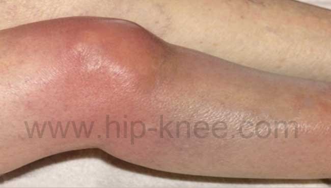 Septic arthritis - Hip and Knee clinic