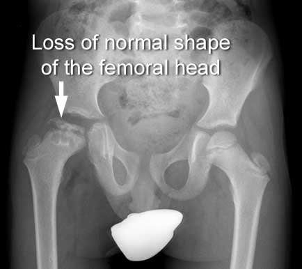 Perthes disease with deformed femoral head