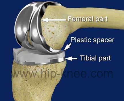 Knee replacement surgery - Hip and Knee clinic