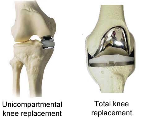 partial and total knee replacement