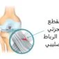 القطع الجزئي في الرباط الصليبي