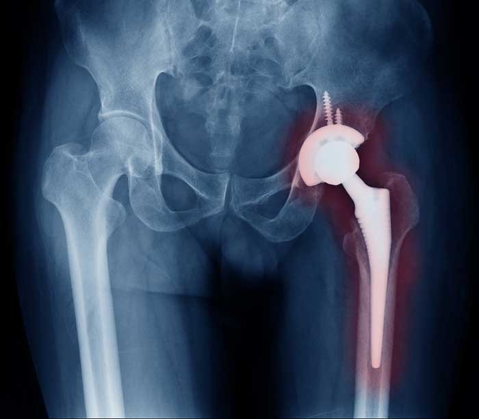 الالتهاب الصديدي بعد جراحة المفصل الصناعي عيادة الركبة و الفخذ