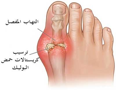 ترسب كريستالات حمض البوليك حول المفصل تؤدي لألتهابه