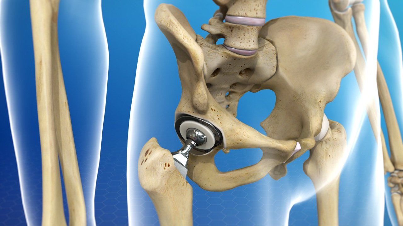 Start walking after hip replacement surgery