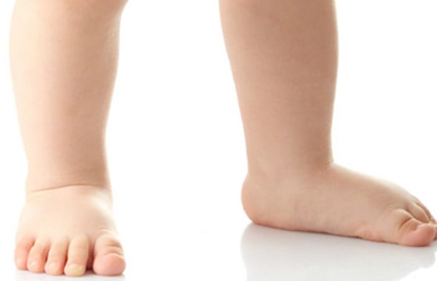 القدم المسطحة الفلات فوت عند الأطفال عيادة الركبة و الفخذ