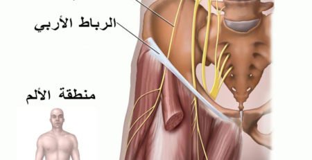 ألم الفخذ المذلي.