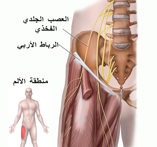 ألم الفخذ المذلي.