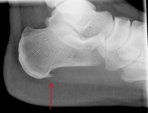 تظهر الشوكة العظمية في صورة الأشعة السينية