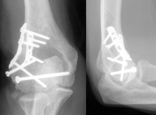 تركيب الشرائح والمسامير لتثبيت وعلاج الكسور - عيادة الركبة و الفخذ