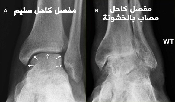 الفرق بين مفصل الكاحل السليم والمتآكل