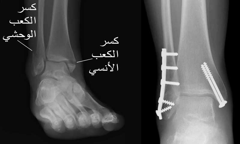 كسور الكاحل (Ankle fractures) عيادة الركبة و الفخذ