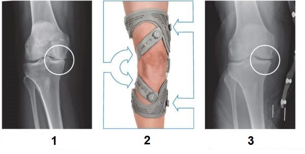 أشعة توضح أثر الركبة الطبية لإعادة توزيع الوزن على ركبة مريض مصاب بالتهاب المفاصل التنكسي