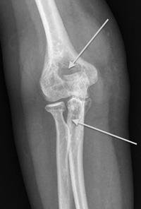 أشعة سينية للنمط الانتشاري في المرفق وتوضح الأشعة ظهور ثقوب بالعظام نتيجة الورم