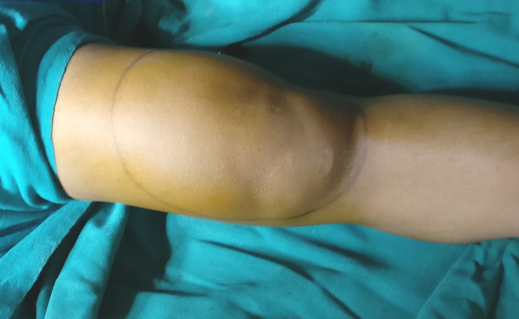 التورم الناتج عن التهاب الغشاء الزلالي الزغابي العقدي المتصبغ في الركبة