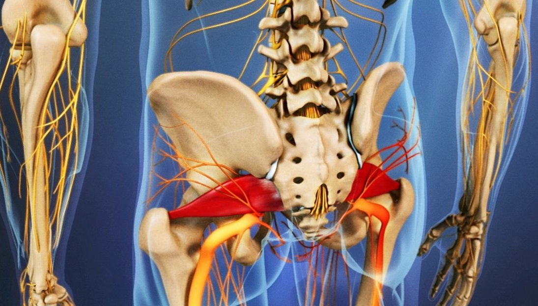 متلازمة العضلة الكمثري
