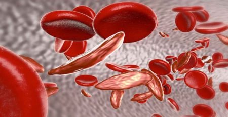 خلايا الدم المنجلية
