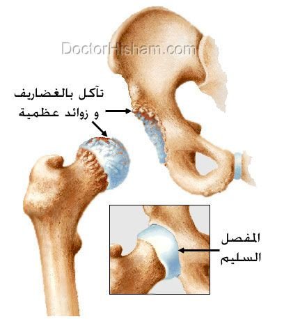 خشونة مفصل الورك