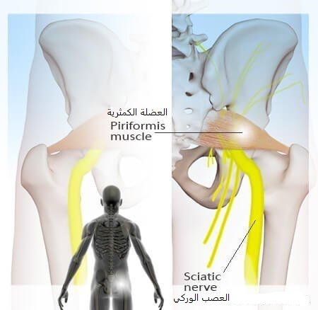 العضلة الكمثرية والعصب الوركي