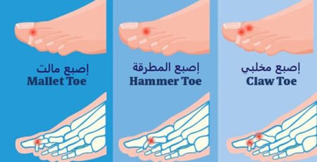 علاج تشوهات أصابع القدم عند أفضل دكتور قدم وكاحل في مصر