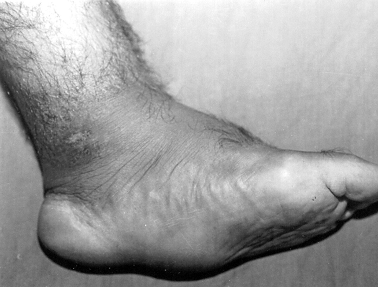 القدم السكري