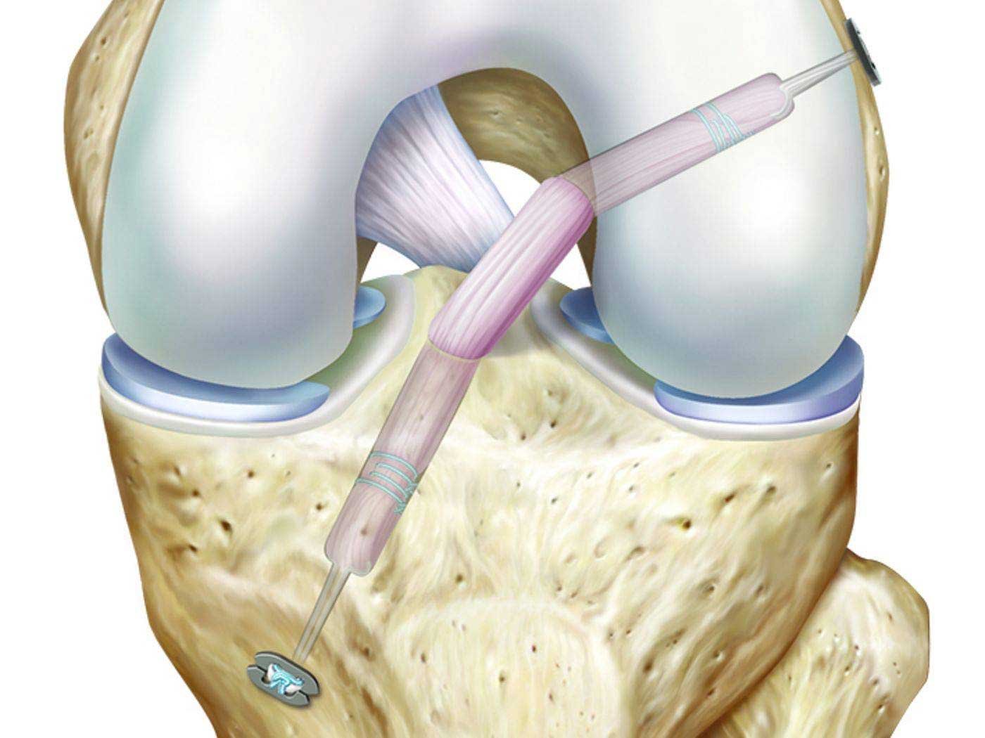 Operácia krížneho väzu cena v Egypte - Klinika kolena a stehien