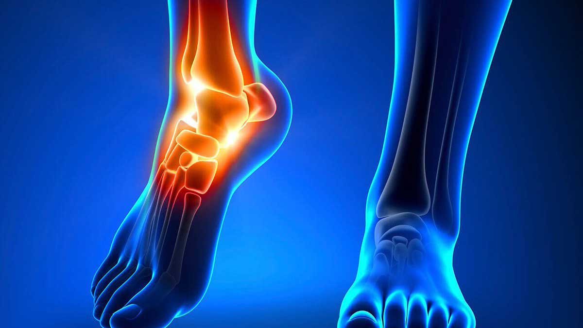 التحام الرسغيات tarsal coalition