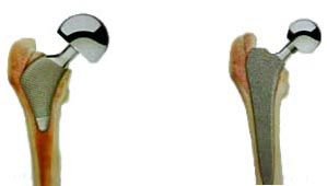 اليمين: مفصل فخذ غير أسمنتي تقليدي أما اليسار: مفصل الفخذ ذو ساق  قصيرة