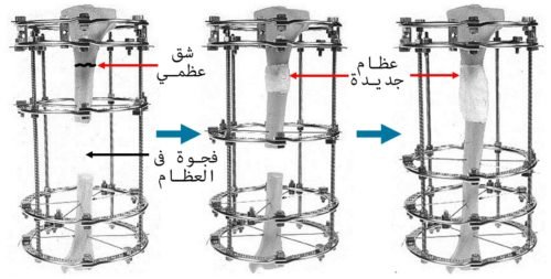 نقل العظام بواسطة المثبت الخارجي (اليزاروف)
