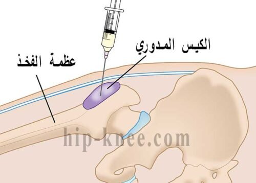 حقن الكيس المدوري كوسيله للعلاج